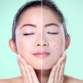 Acne Skin